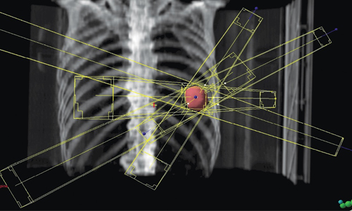 Radioterapia estereotáxica